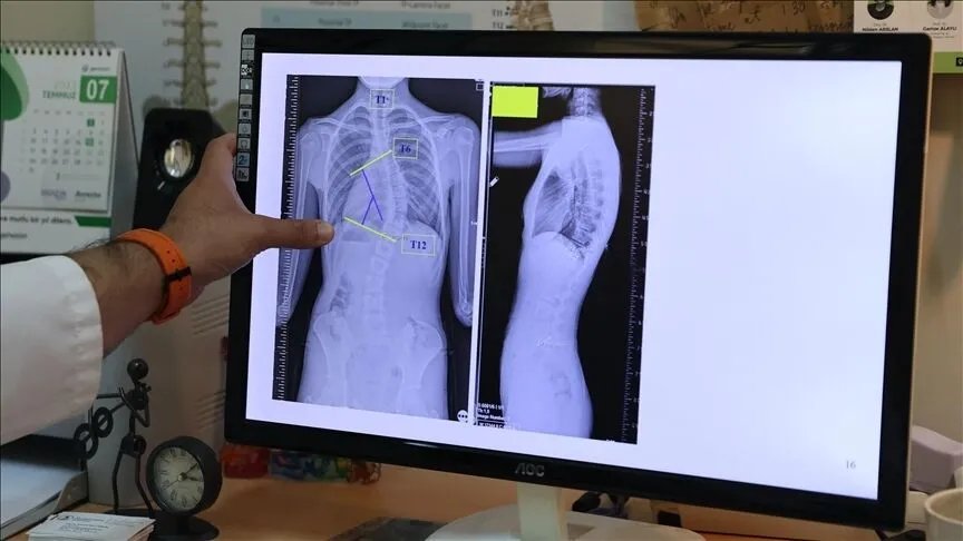 Okuldaki gizli tehlike! Veliler dikkat, sessizce ilerliyor... Her zaman ağrı olmuyor