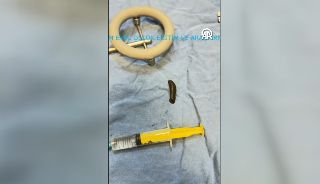 Boğazından çıktı hem de canlı! 2 hafta ağrı çekti, kan tükürdü, korkunç gerçeği hastanede öğrendi