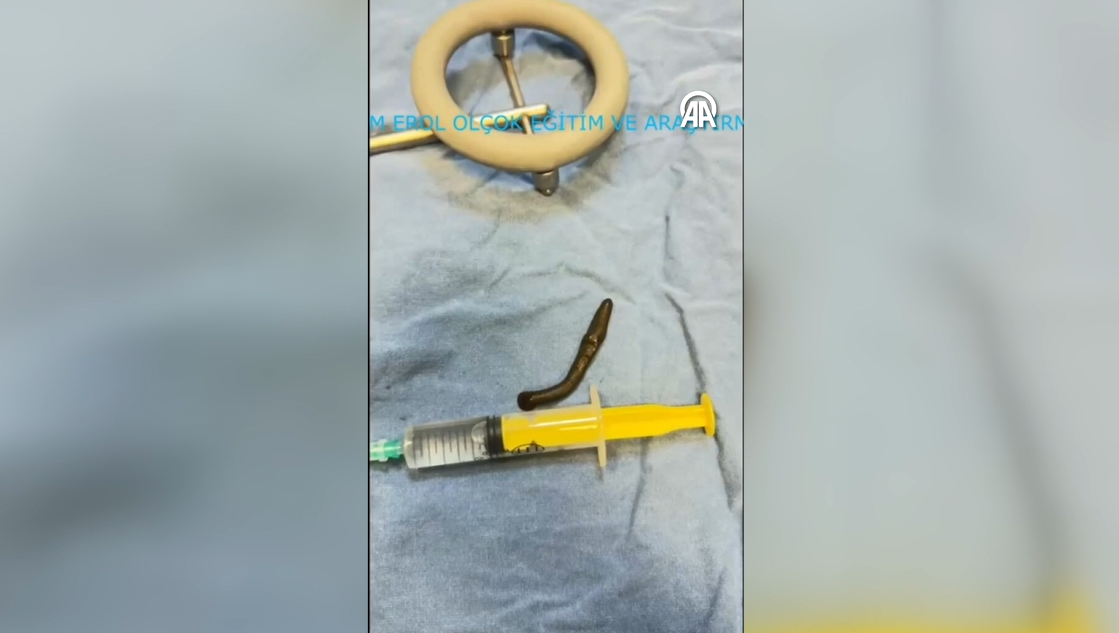 Boğazından çıktı hem de canlı! 2 hafta ağrı çekti, kan tükürdü, korkunç gerçeği hastanede öğrendi