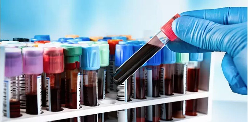 İlk belirtilerden yaklaşık 20 yıl önce başlıyor! Kandan Alzaymır teşhisi dönemi