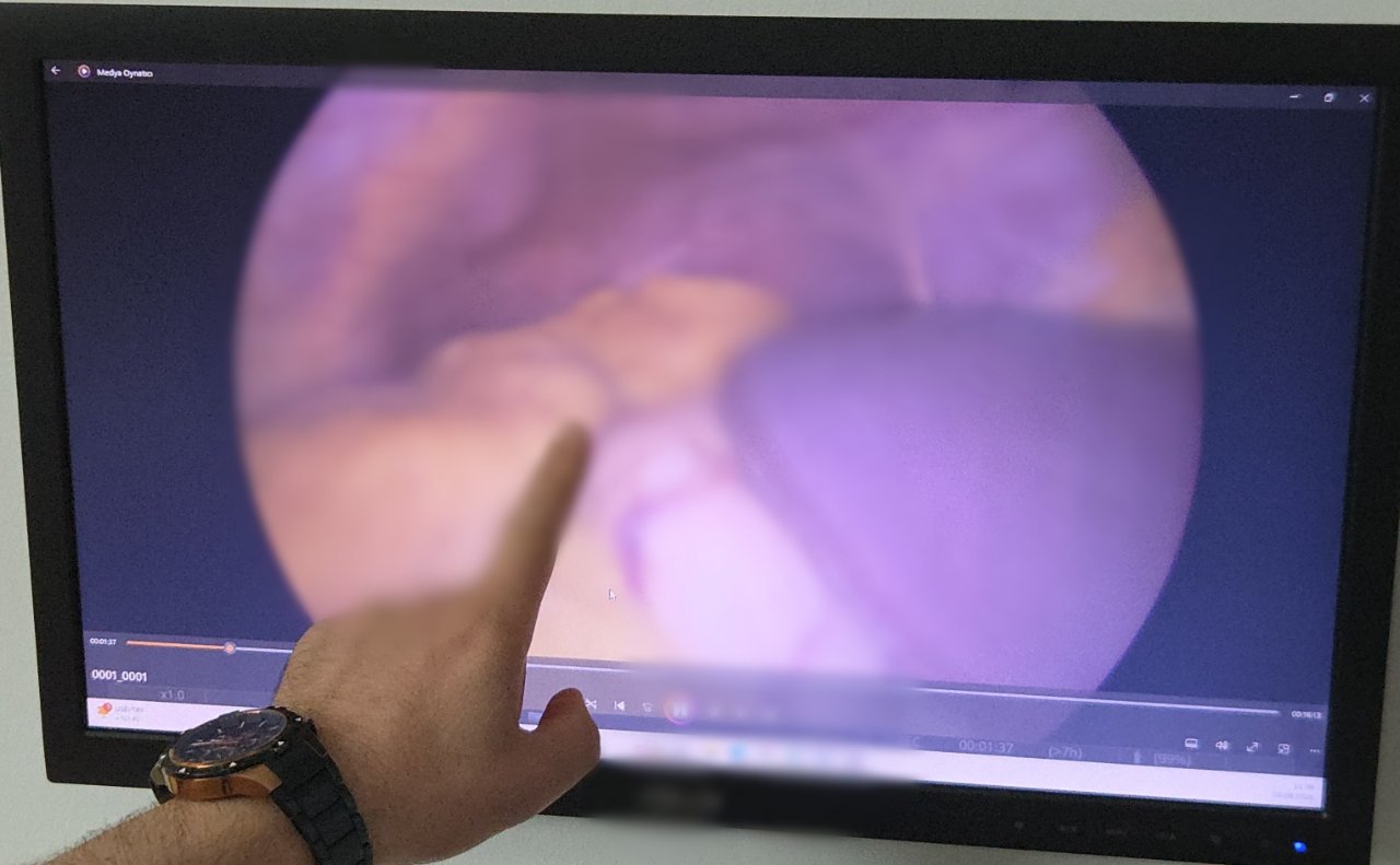 Gerçeği 54 yaşında öğrendi! Kalbi sağda, diğer organları da ters yerde… 10 binde 1 görülüyor