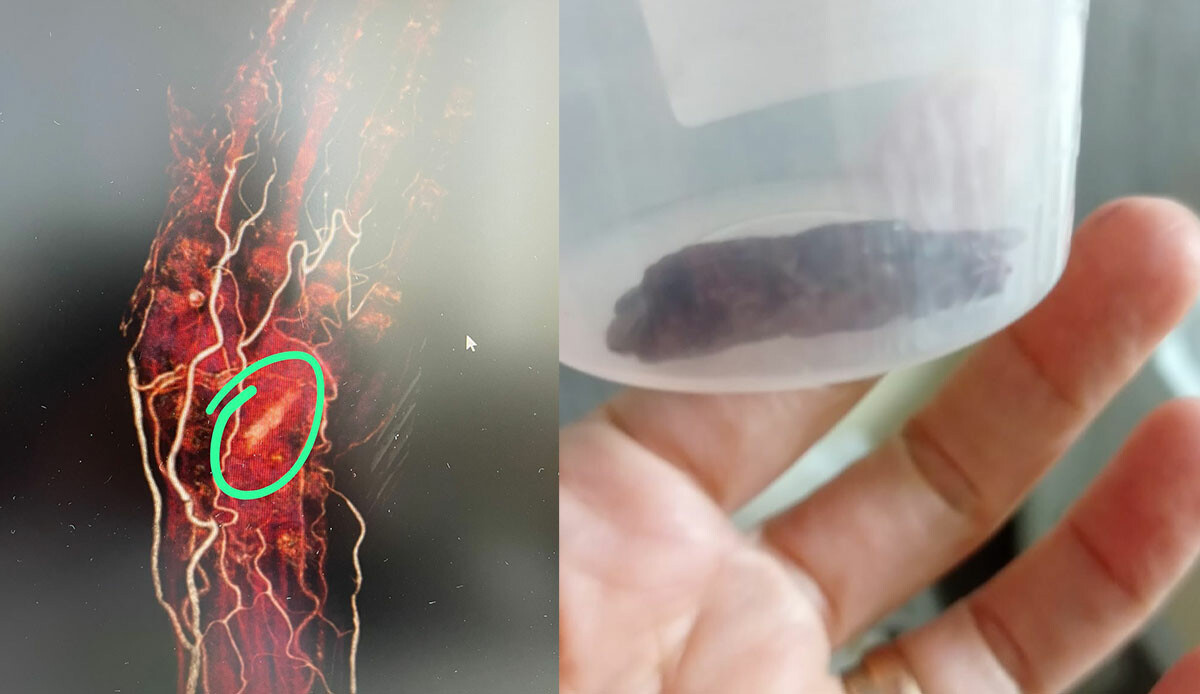 Doktor 'tembellikten oluyor' dedi... Yaşlı kadının elinden çıkanlar şoke etti