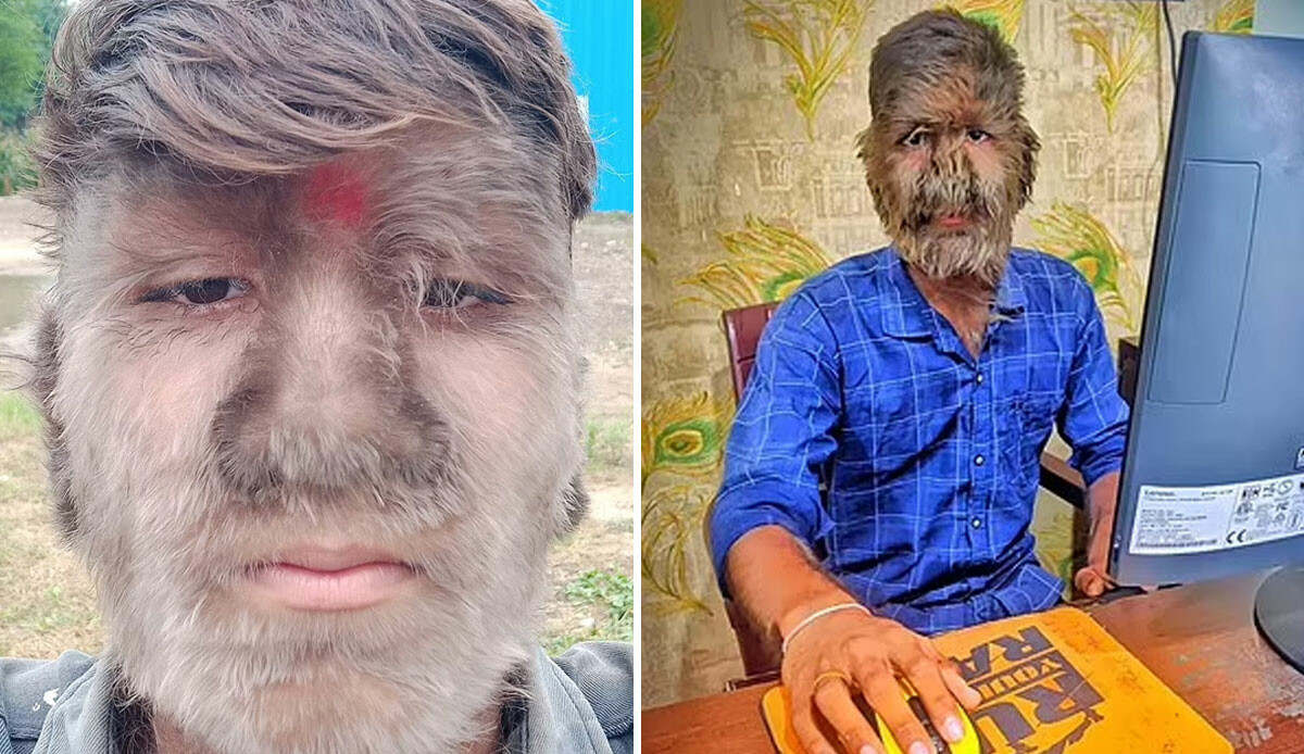 Orta çağdan bu yana 50 kişide görüldü! 17 yaşındaki genç, kurt adama dönüştü