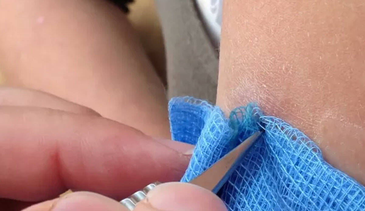 Mide bulandıran görüntüler! Geçmeyen kol ağrısı için doktora gitti, korkunç gerçek ortaya çıktı: Büyük şok yaşadı