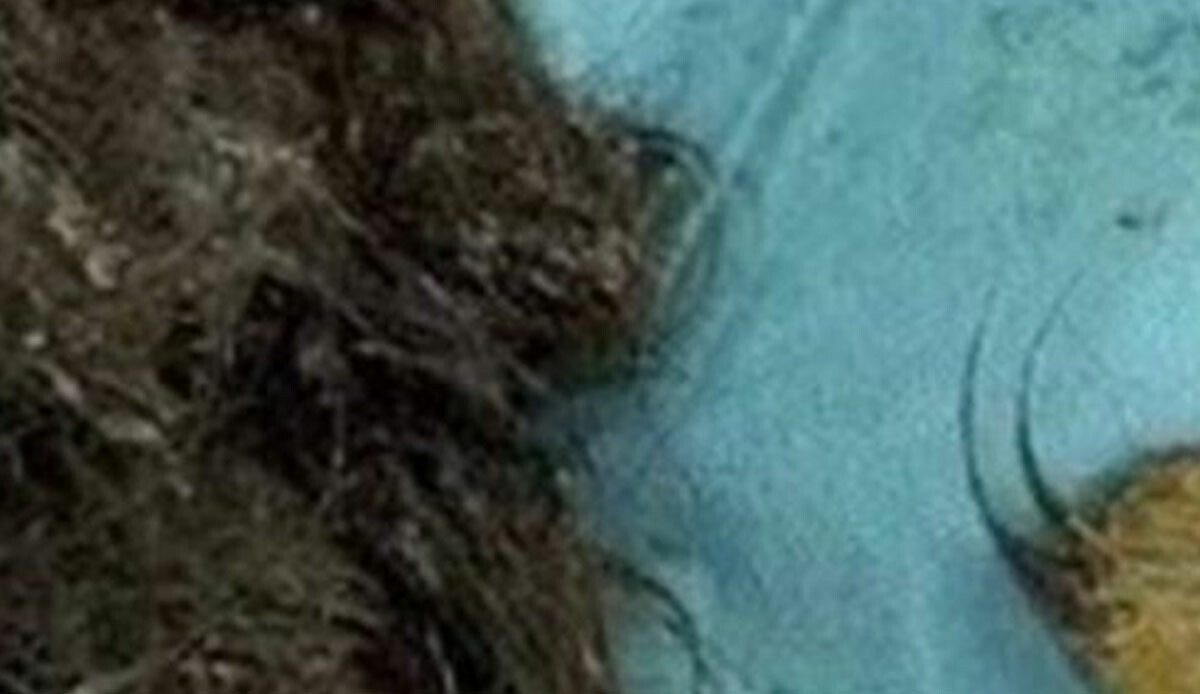 14 yaşındaki kız yemek yiyemediği için gittiği doktorda hayatının şokunu yaşadı! Cerrahlar dahi inanamadı: Bağırsakları, midesi... 14 yaşındaki kız yemek yiyemediği için gittiği doktorda hayatının şokunu yaşadı! Cerrahlar dahi inanamadı: Bağırsakları, midesi...