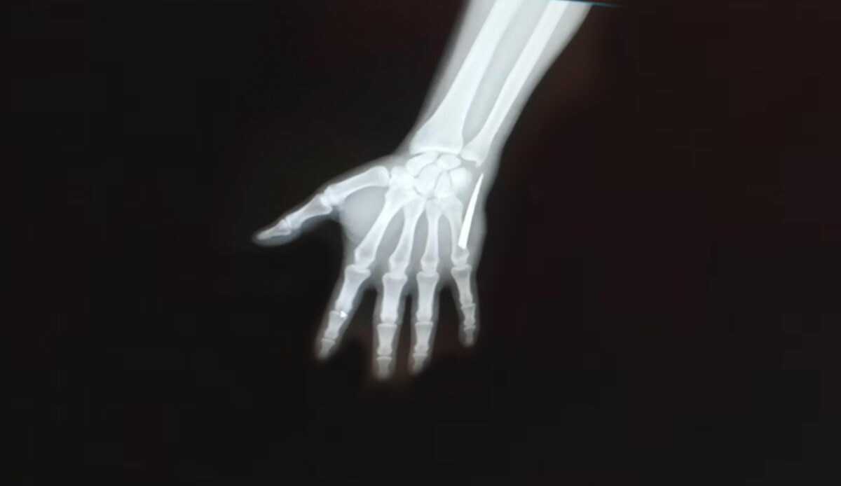 Şoke eden olay! Uyuşma ve ağrı nedeniyle gitti, bir röntgenle korkunç gerçek ortaya çıktı