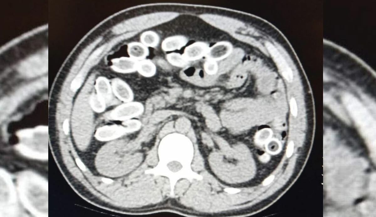 Polis şüphesiyle durduruldu, midesinden çıkanlar şoke etti! İnanılmaz