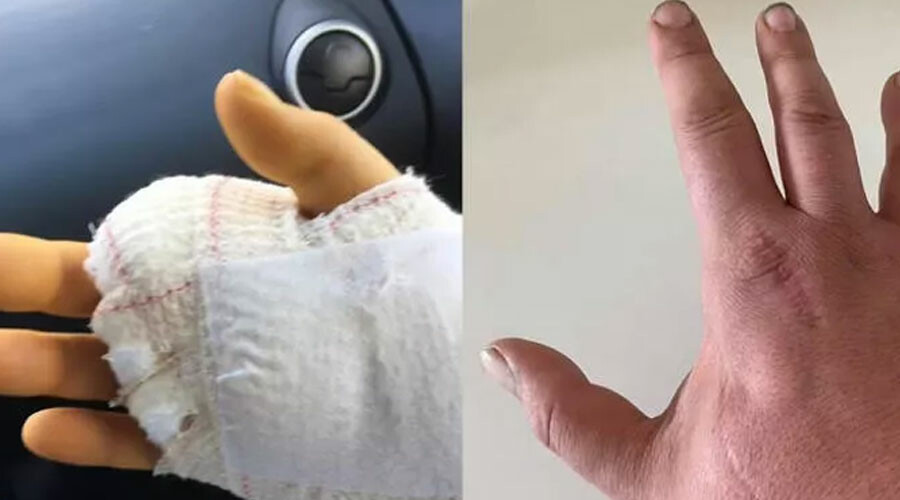 Küçük bir ısırık demeyin! Barınaktan aldığı kedi sonu oldu… Parmağı kesildi ama kurtulamadı