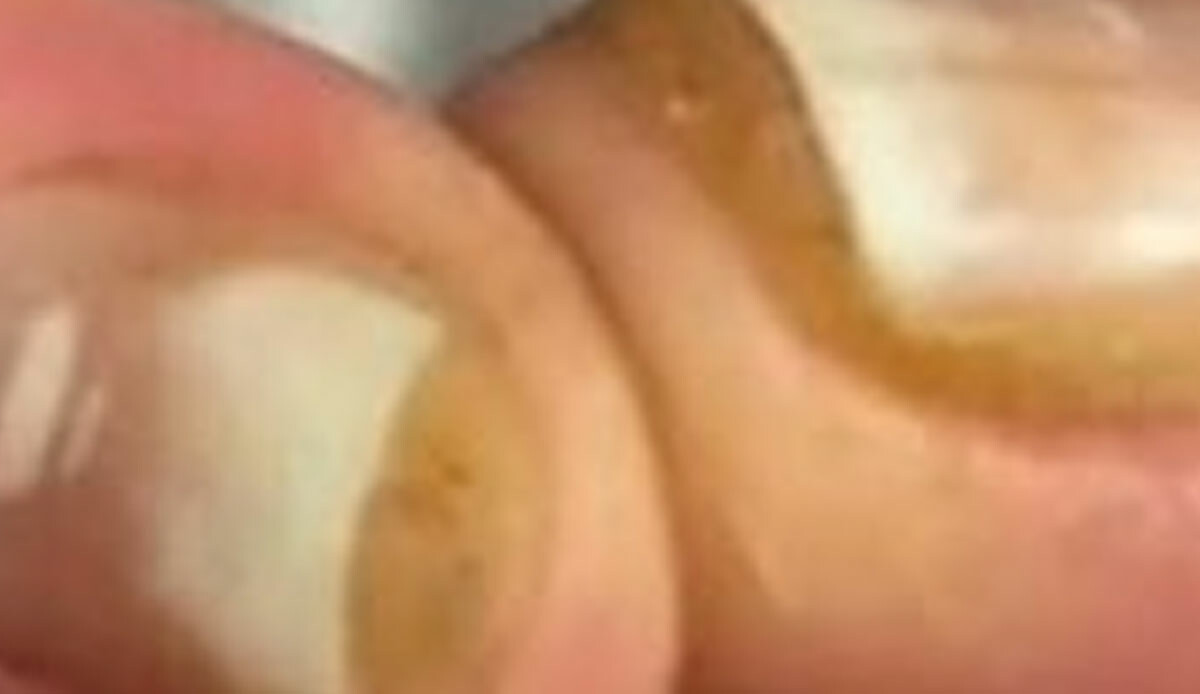 Sakın evde denemeyin! Evde jel tırnak yapmak isterken kabusu yaşadı: Tırnaklarının son hali korkunç