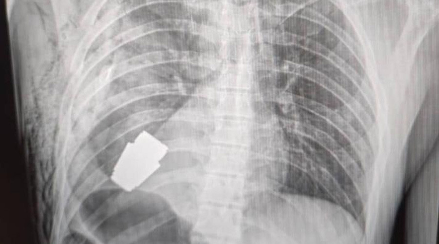 Doktorlar bile şaşkın! Vücudundan el bombası çıktı: ‘Her an patlayabilir’ Doktorlar bile şaşkın! Vücudundan el bombası çıktı: ‘Her an patlayabilir’