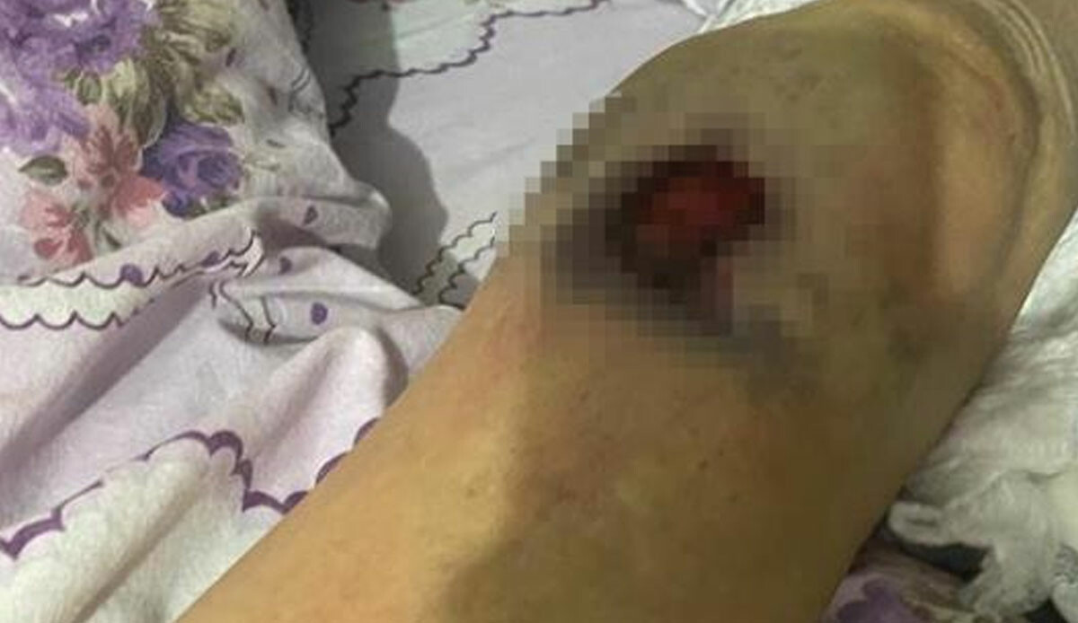 Başkentte bakıcı dehşeti! 91 yaşındaki kadın ölüm kalım savaşı veriyor: İddialar korkunç Başkentte bakıcı dehşeti! 91 yaşındaki kadın ölüm kalım savaşı veriyor: İddialar korkunç