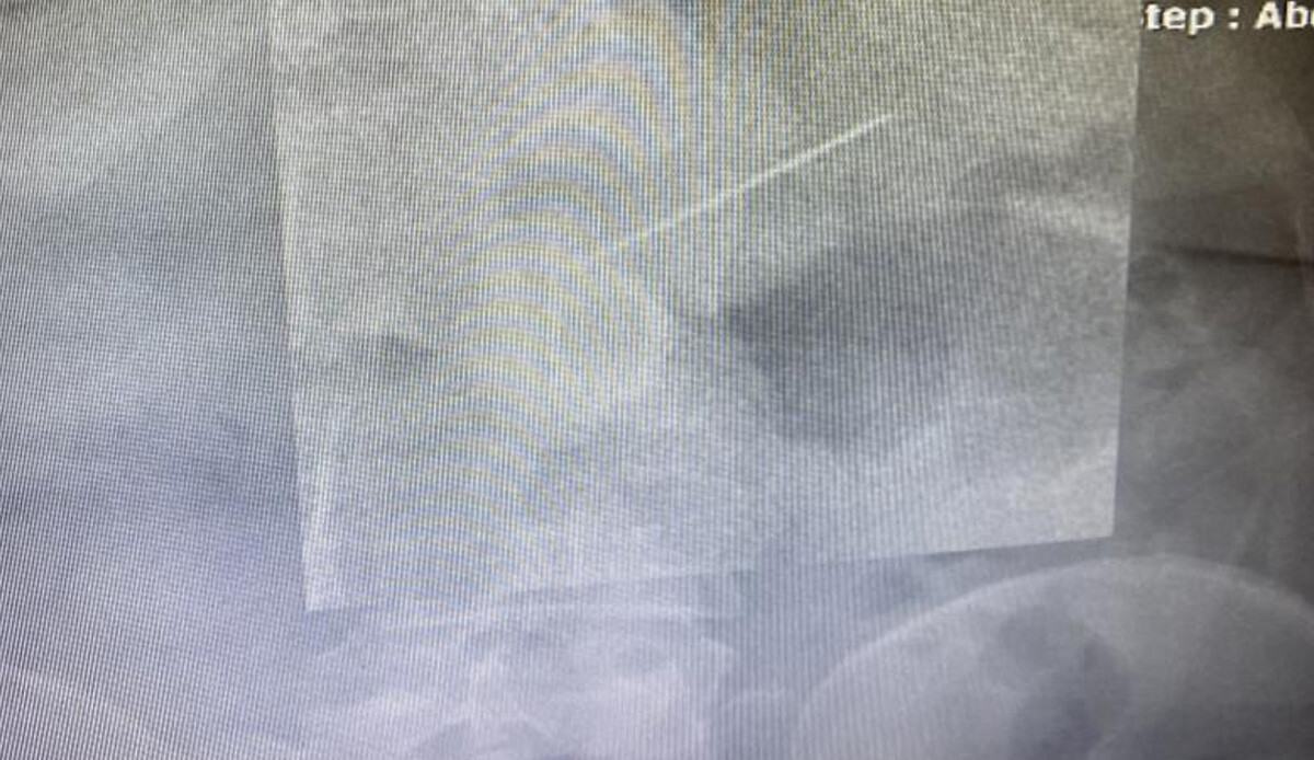 Akıllara durgunluk veren olay! Başörtü takarken hapşırdı, ağzındaki iğneyi yuttu