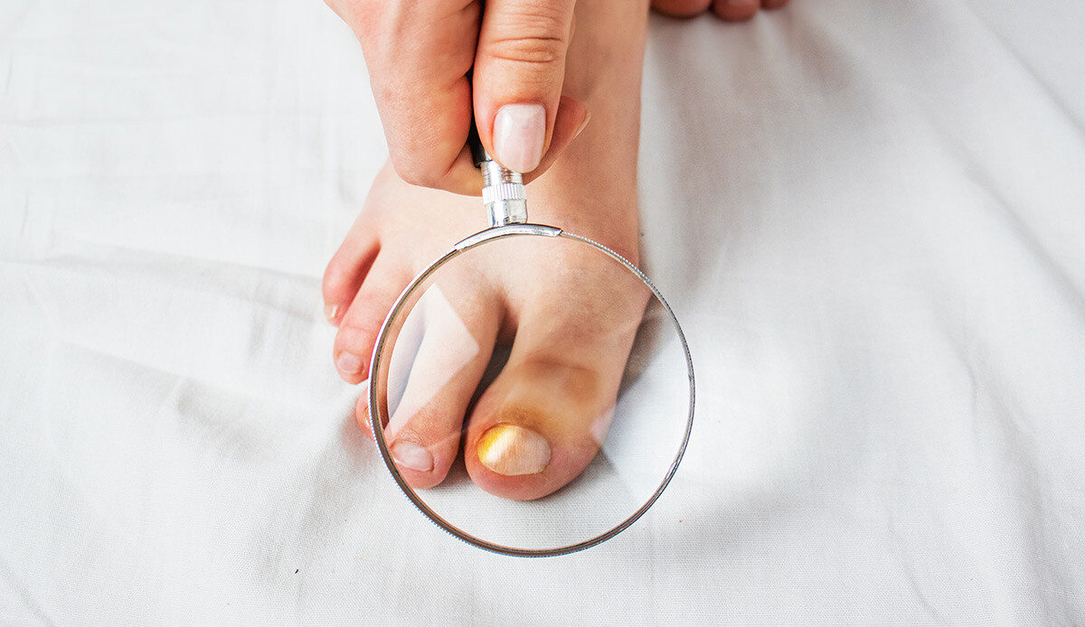 Evde doğal çözüm… Ayak mantarının kökünü kazıyor, deneyenler hemen kurtuluyor