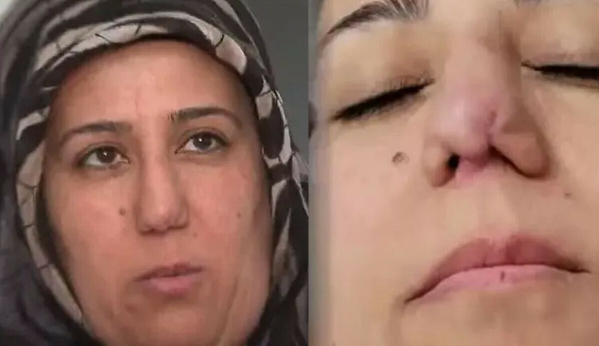 Burun estetiği yaptıran kadının hayatı kabusa döndü! Aynaya baktığında neye uğradığını şaşırdı: Şok üstüne şok yaşadı Burun estetiği yaptıran kadının hayatı kabusa döndü! Aynaya baktığında neye uğradığını şaşırdı: Şok üstüne şok yaşadı