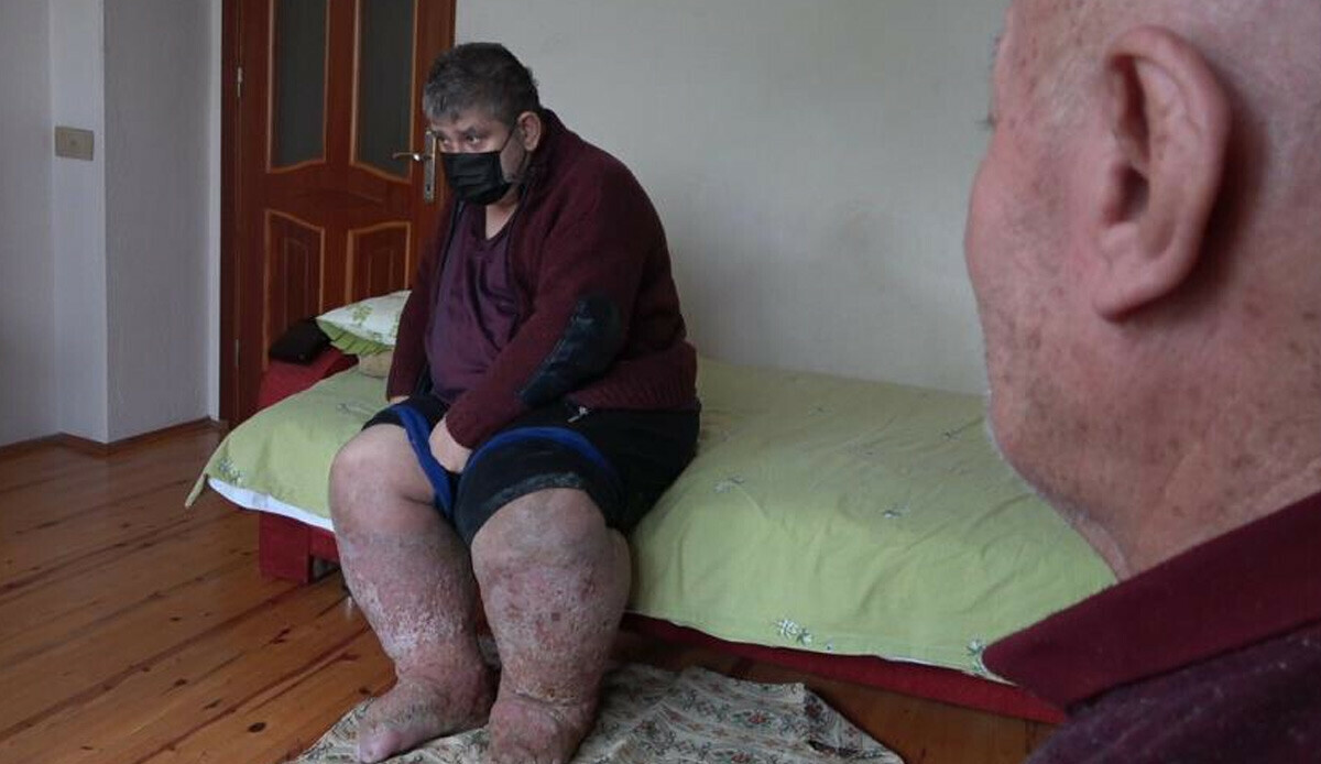Sivrisinek ısırığı hayatını kararttı! 9 yıldır insan içine çıkamıyor, bacakları gittikçe genişliyor