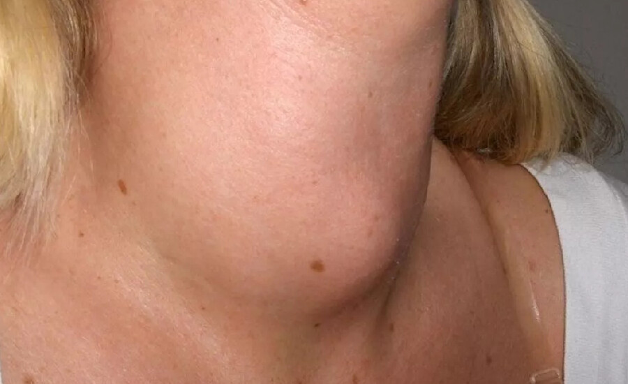 Cushing sendromu nedir? Nedenleri, belirtileri, tedavisi, testi