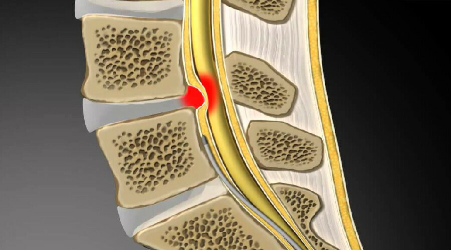 Priformis sendromu nedir? Nedenleri, belirtileri, tedavisi, testi Priformis sendromu nedir? Nedenleri, belirtileri, tedavisi, testi