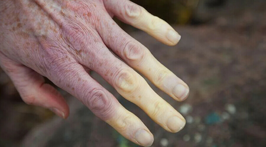 Raynaud sendromu nedir? Nedenleri, belirtileri, tedavisi, testi Raynaud sendromu nedir? Nedenleri, belirtileri, tedavisi, testi