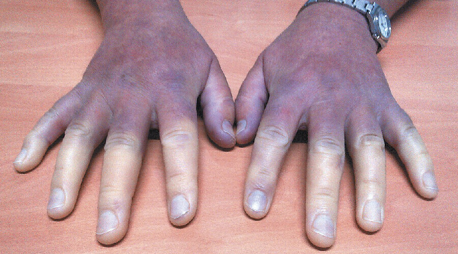 Raynaud sendromu nedir? Nedenleri, belirtileri, tedavisi, testi Raynaud sendromu nedir? Nedenleri, belirtileri, tedavisi, testi