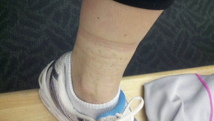 İlk belirtisi ayak bileklerinde ortaya çıkıyor! Çoğu kişide görülen hastalık...