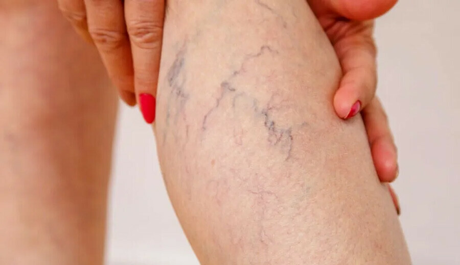 İlk belirtisi ayak bileklerinde ortaya çıkıyor! Çoğu kişide görülen hastalık...