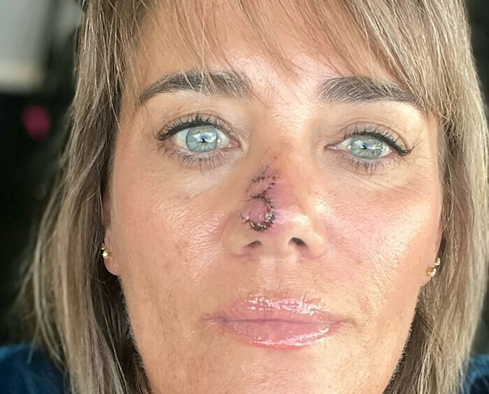 Sivilcesi geçmeyince doktora gitti, altından bambaşka bir şey çıktı Sivilcesi geçmeyince doktora gitti, altından bambaşka bir şey çıktı