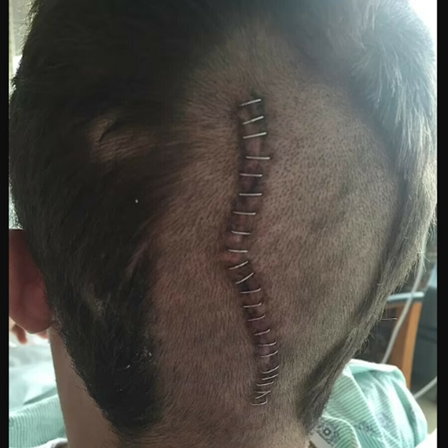 Hayatı bir anda kabusa döndü: Genç adam hapşırırken beyin kanaması geçirdi