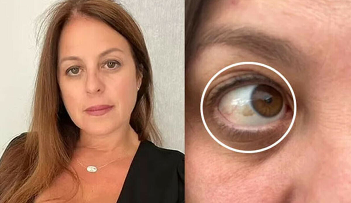 Gözdeki lekeye dikkat: Genç kadın kör kaldı