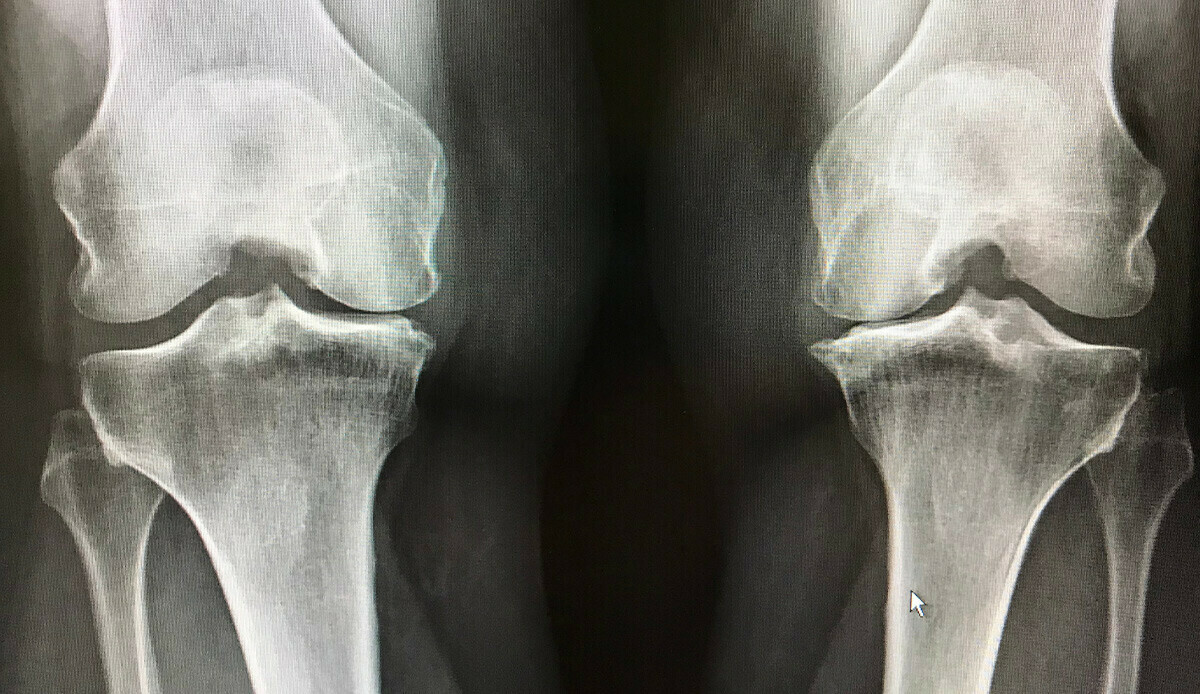 ‘Her yerim ağrıyor, kemiklerim sızlıyor’ diyenler dikkat! Sebebi belli oldu