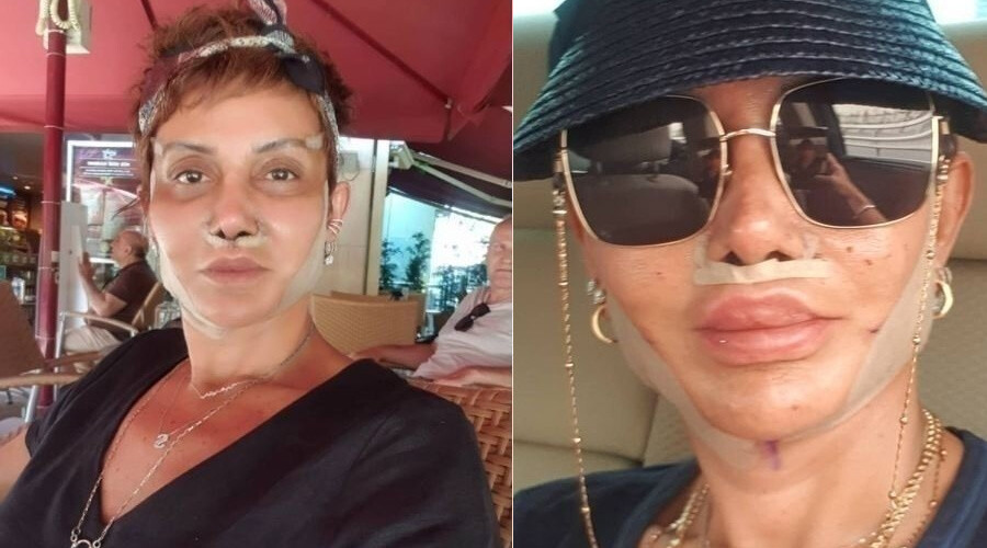 “Estetiği kendimi iyi hissetmek için yaptım” diyen Serap Paköz’ün son hali gündem oldu “Estetiği kendimi iyi hissetmek için yaptım” diyen Serap Paköz’ün son hali gündem oldu