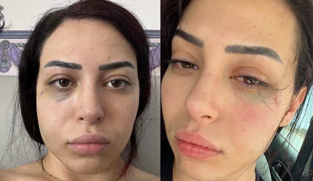 25 yaşındaki Türk kızına saldırıp hastanelik eden 2 Rum tutuklandı