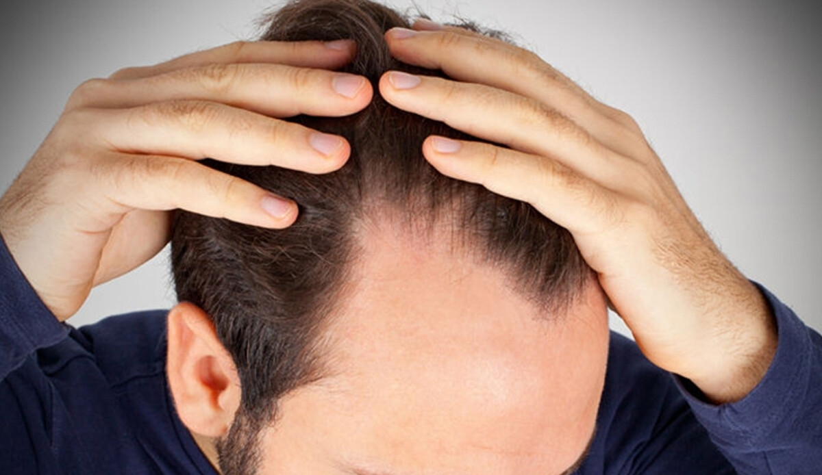 Kelliğe çare bilim adamlarından geldi: Genleri hackleyip saç çıkardılar