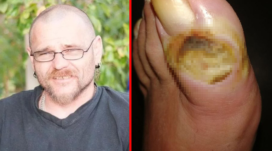 Terlik giyen adamı ısırdı, ayağı çürüdü… Ameliyat olacağı günü dört gözle bekliyor