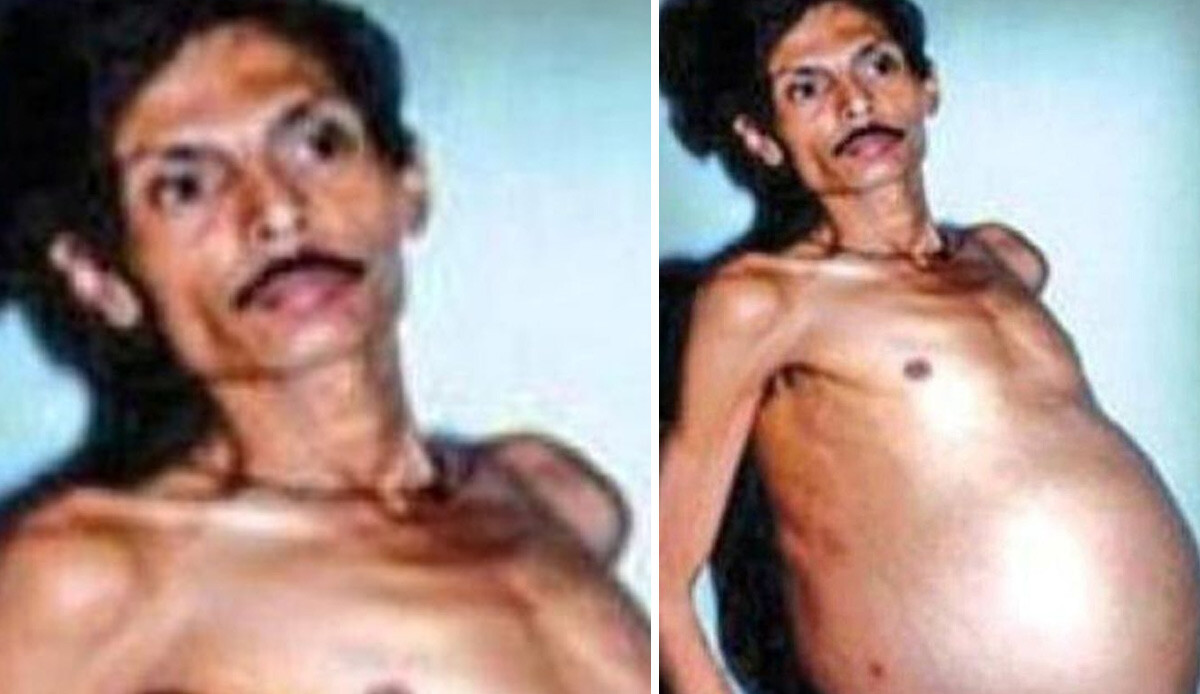 Hamile gibi görünen adam herkesi şaşırttı, gerçek 36 yıl sonra ortaya çıktı Hamile gibi görünen adam herkesi şaşırttı, gerçek 36 yıl sonra ortaya çıktı