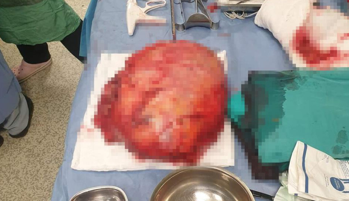 Ağrıyan ayakları nedeniyle gittiği hastanede şoke eden gerçeği öğrendi! Tam 8 kilo ağırlığında