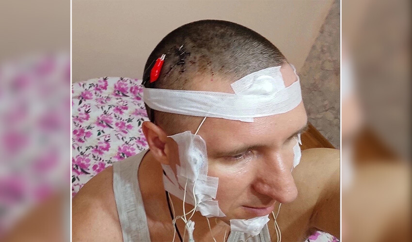 Kafasını matkapla deldi, çip yerleştirdi, yine de ölmedi Kafasını matkapla deldi, çip yerleştirdi, yine de ölmedi
