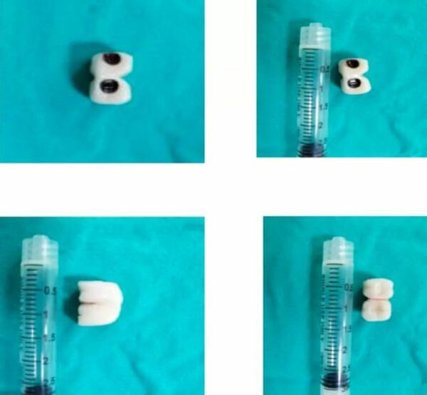 Diş&ccedil;ide implantı yuttu
