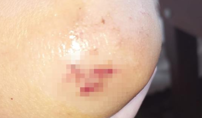 Sokak köpekleri yine dehşet saçtı! Çocuğu ölümden dönen baba: Bizim canımız yandı, başkalarının canı yanmasın!