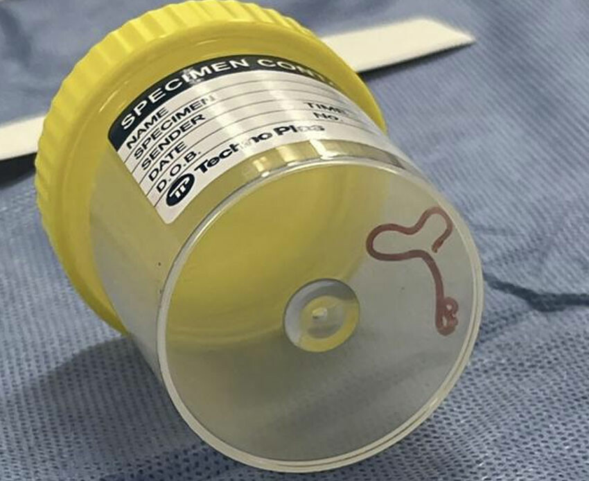 Unutkanlık ve depresyon şikayetiyle doktora gitti: Beyninde piton yılanlarında bulunan solucan çıktı Unutkanlık ve depresyon şikayetiyle doktora gitti: Beyninde piton yılanlarında bulunan solucan çıktı