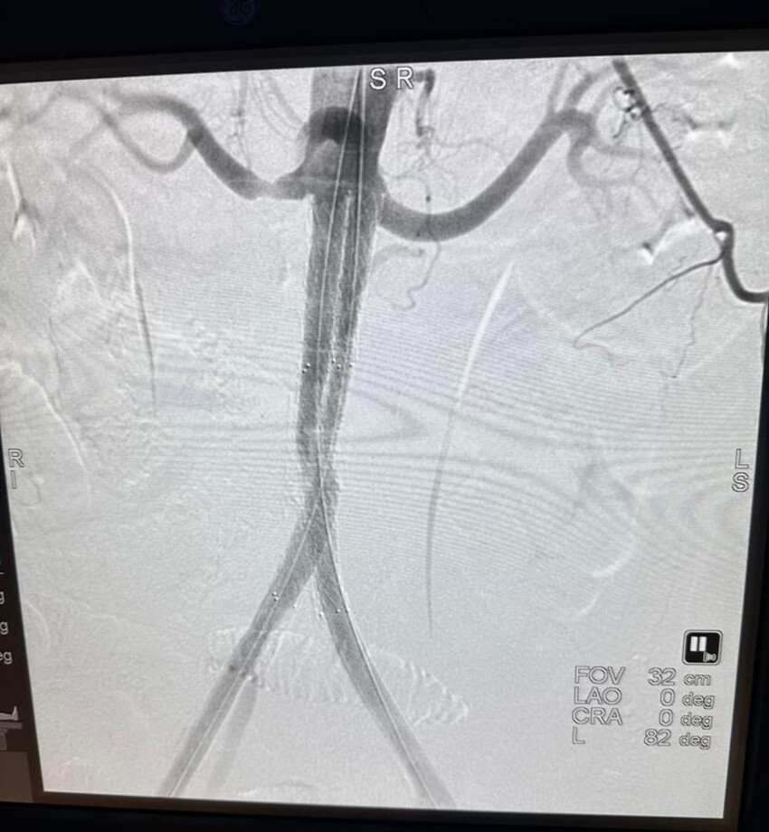 Sağlıkta atağa geçtik, yerli üretim yapay damar hayat kurtardı