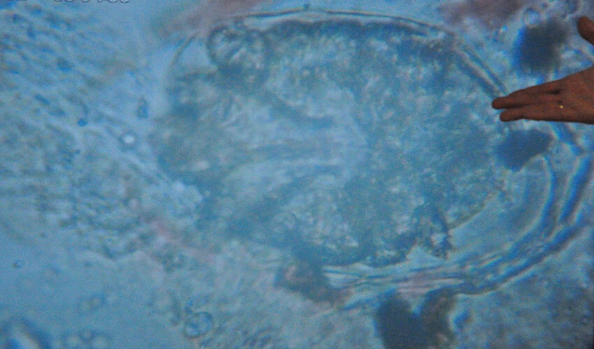 Uyuz hastalığı pandemiyle hortladı: Görülme sıklığı yüzde 50 arttı