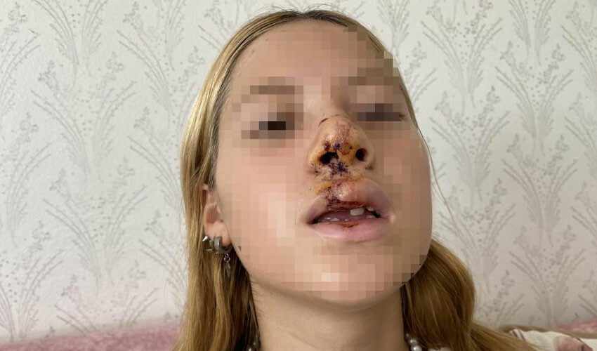 Kaldırım taşı atılan kız ilk kez konuştu: Hayatım karardı, yüzüm değişti Kaldırım taşı atılan kız ilk kez konuştu: Hayatım karardı, yüzüm değişti