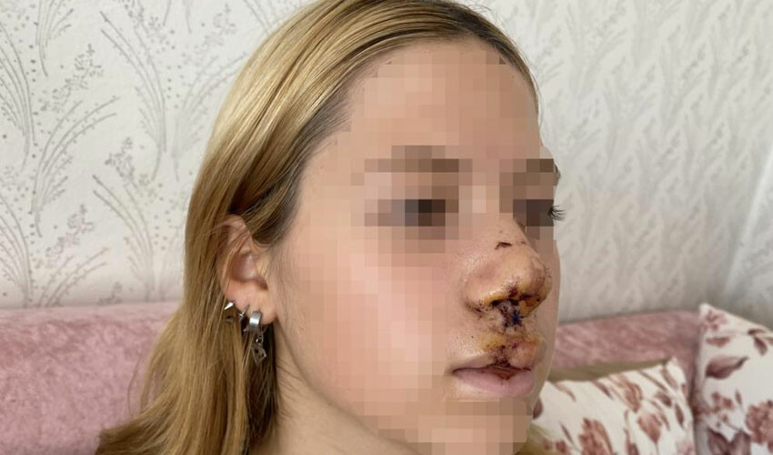 Kaldırım taşı atılan kız ilk kez konuştu: Hayatım karardı, yüzüm değişti Kaldırım taşı atılan kız ilk kez konuştu: Hayatım karardı, yüzüm değişti