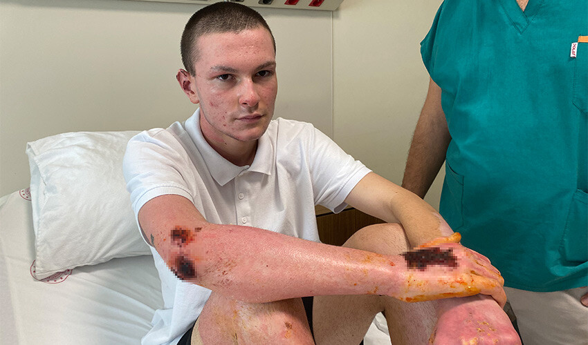 Deodorant sıkılırken çakmak çaktılar, 16 yaşındaki genç ölümden döndü Deodorant sıkılırken çakmak çaktılar, 16 yaşındaki genç ölümden döndü