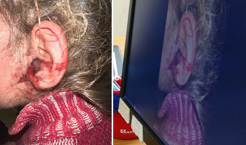 Küçük kızın kulağından çıkanlar şoke etti: 23 adet canlı çıkarıldı Küçük kızın kulağından çıkanlar şoke etti: 23 adet canlı çıkarıldı