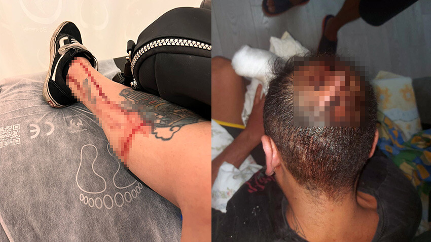 Kafasında şişe patlattılar