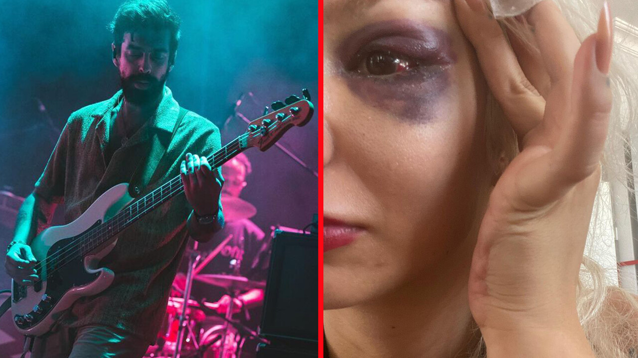 Yüzyüzeyken Konuşuruz’un gitaristi Can Tunaboylu’nun kız arkadaşından darp iddiası: Yüzünün mosmor halini paylaştı Yüzyüzeyken Konuşuruz’un gitaristi Can Tunaboylu’nun kız arkadaşından darp iddiası: Yüzünün mosmor halini paylaştı