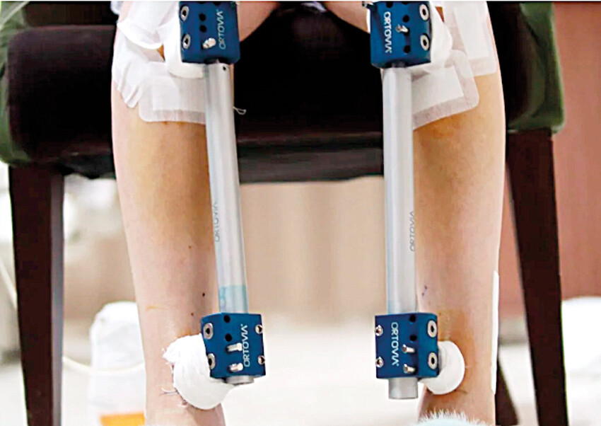 Uzmanlar boy uzatma ameliyatları konusunda uyardı: Saç ektirmeye benzemez