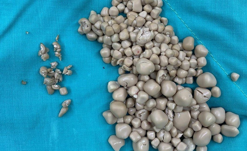 Tayvanlı kadının böbreklerinden 300 taş çıkarıldı Tayvanlı kadının böbreklerinden 300 taş çıkarıldı