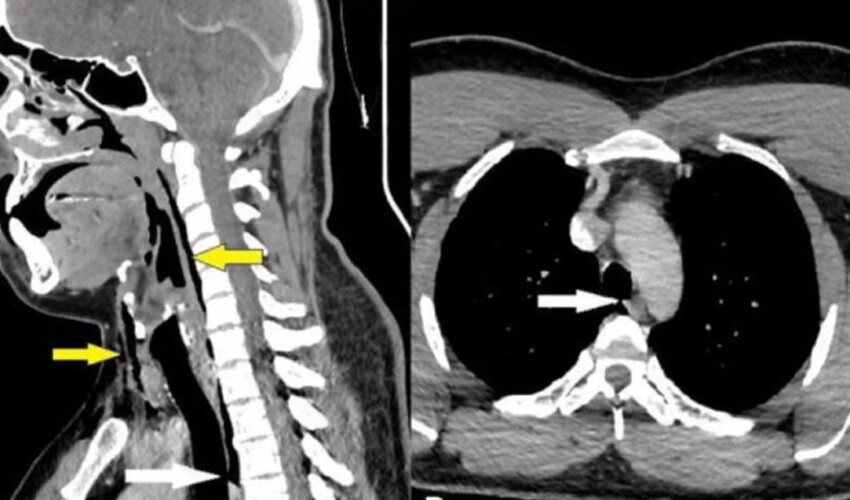 Hapşırığını tutmaya çalışırken boğazı patladı! Hapşırığını tutmaya çalışırken boğazı patladı!